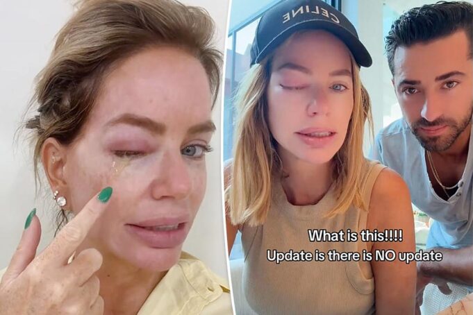 Кэролайн Стэнбери говорит, что ее глаз «может взорваться», так как он сочится в брезгром видео из -за «болезненной» инфекции