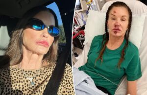 Дженис Дикинсон поделилась ужасными фотографиями с осени, из-за которых ее лицо навсегда изуродовалось