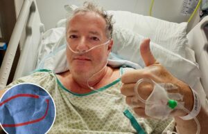 Пирс Морган, 60 лет, госпитализирован, ему предстоит замена тазобедренного сустава после перелома бедренной кости при падении.